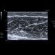 Thrombosis of muscular veins of the calf, fracture of the fibular ankle and plaster cast: US - Ultrasound